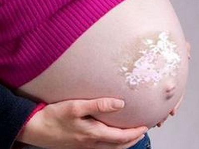 孕妇该怎么预防白癜风