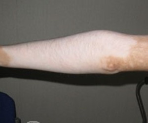 肢端型白癜风对男性有哪些危害