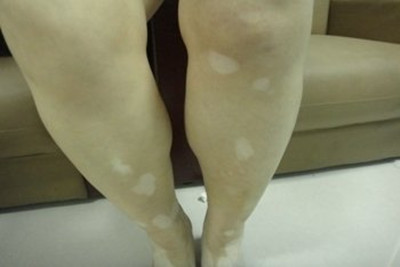 北京最好白癜风医院：怎么诊断腿上的白斑